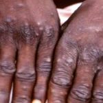 Monkeypox Hits Lagos, 2 Suspected Cases Reported