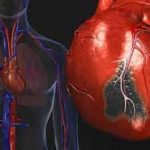 Expert Says Ischemic Heart Disease Can Lead To Death
